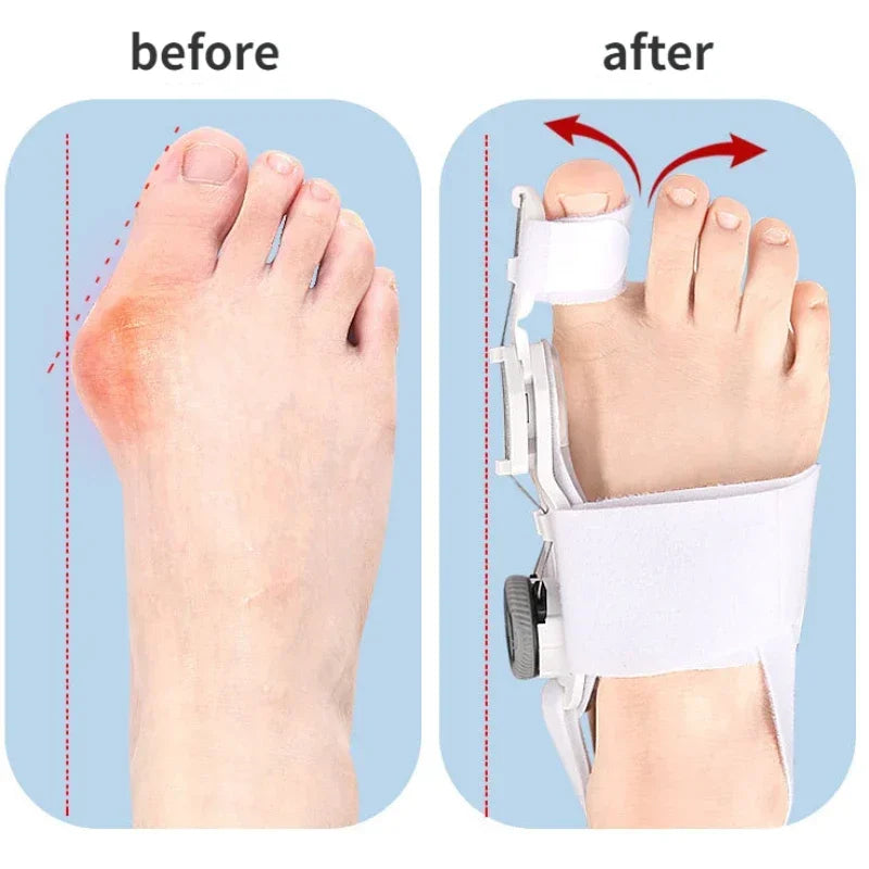 1PC Bunion Corrector Unisex Foot Hallux Valgus Braces Rotatable Toe Separator Straightener Adjustable Finger Toe Corrector